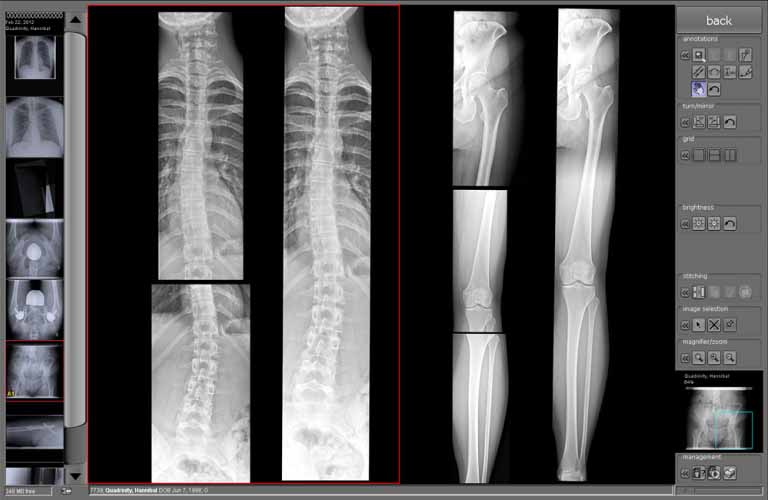 The stitching module merges a number of separate digital X-ray images into a single image