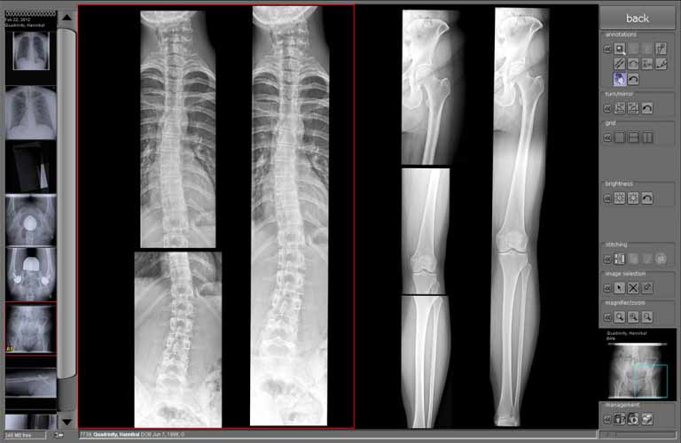 The stitching module merges a number of separate digital X-ray images into a single image