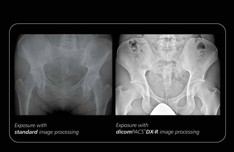 Due to specially developed processes, the image processing allows the user to while the image quality vary the X-ray settings on a large scale remains virtually the same 