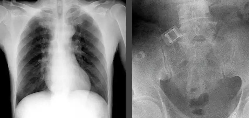 Dynamic X-ray the special acquisition mode supports the assessment of moving structures