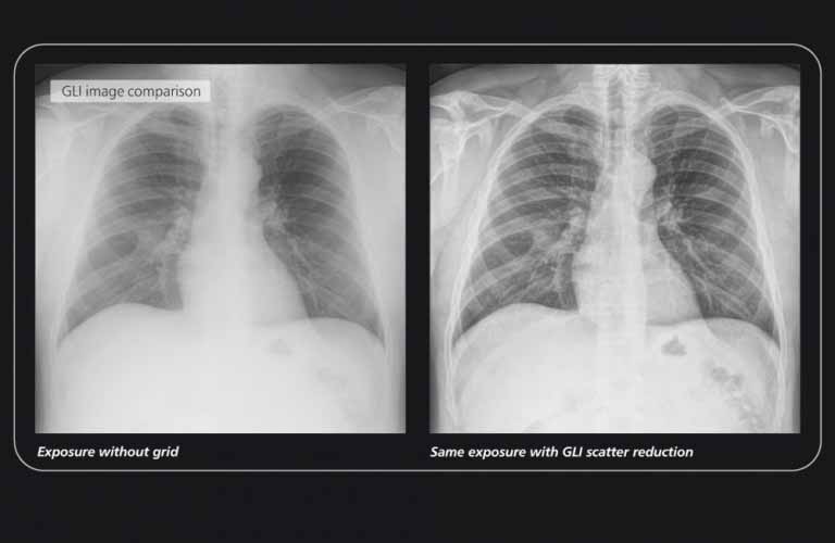 GLI (gridless imaging) – reduction of scattered radiation: professional dicomPACS DX-R  image processing