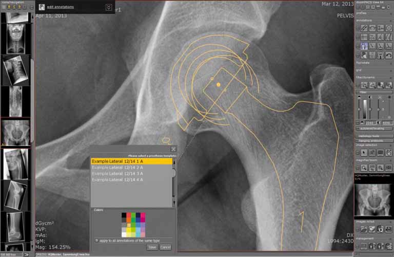  Prosthesis documentation: For surgical planning using the digital prosthesis templates provided by manufacturers