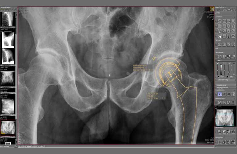 Planning of an artificial hip joint with digital templates