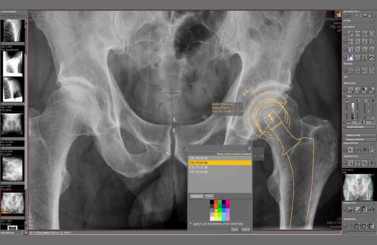  Prosthesis documentation with digital templates