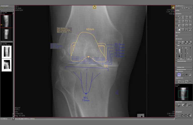 Preoperative surgery planning with the prosthesis documentation module