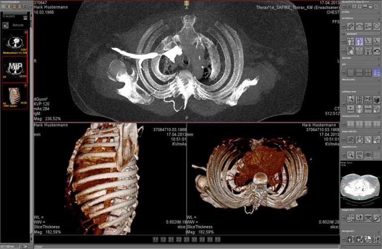 El software PACS informa de las imágenes seccionales para CT y MRT (Hanging Protocols, Cine Loop, MPR, MIP etc.)