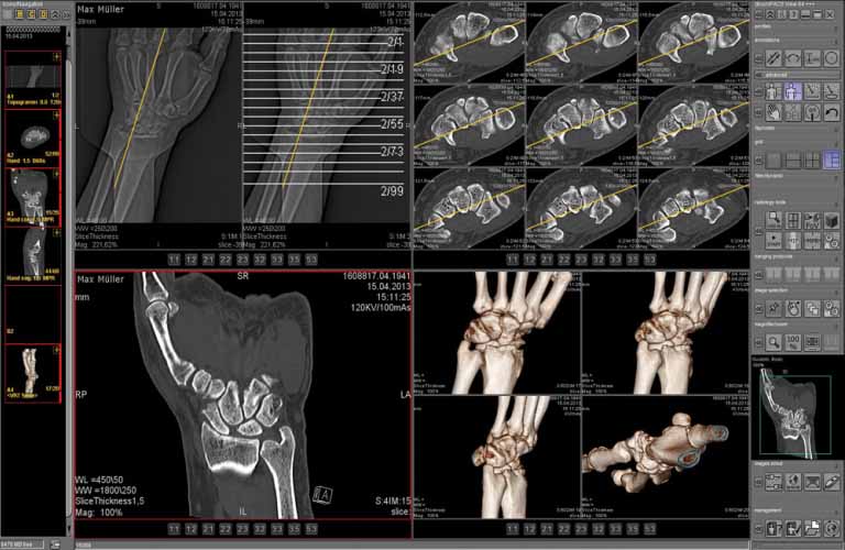 MPR (Multi Planar Reconstruction) and MIP (Maximum Intensity Projection) functions