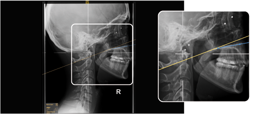 NUCCA: S-Line and Hard Palate Line