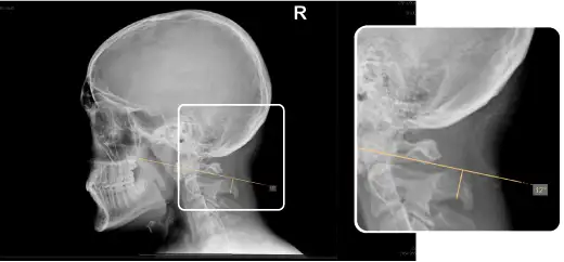 Chiro Orthogonal line