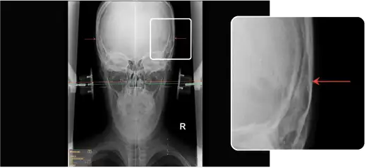 NUCCA: Squamous Sutures