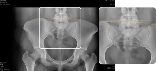 Chiro Horizontal or vertical level