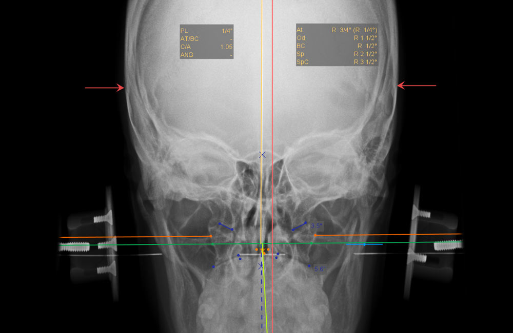 upper-cervical-nucca-and-standard-chiropractic-tools