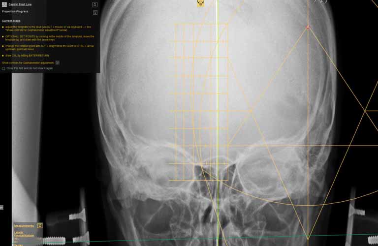 Diagnostiktools für Upper Cervical Chiropractic (NUCCA)