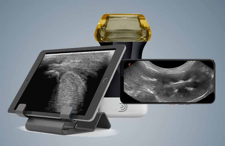 Mobile sonography with small hnadal ultrasound scanners